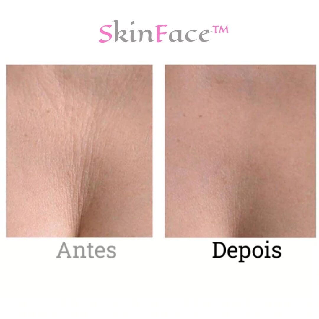 SkinFace™ - Adesivos de Silicone Rejuvenescedor Anti Rugas - True Inovare